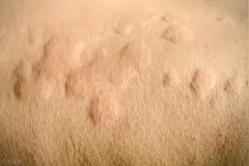 荨麻疹有效治疗方法有哪些？看看风湿科医生说的，2类药物很管用图片