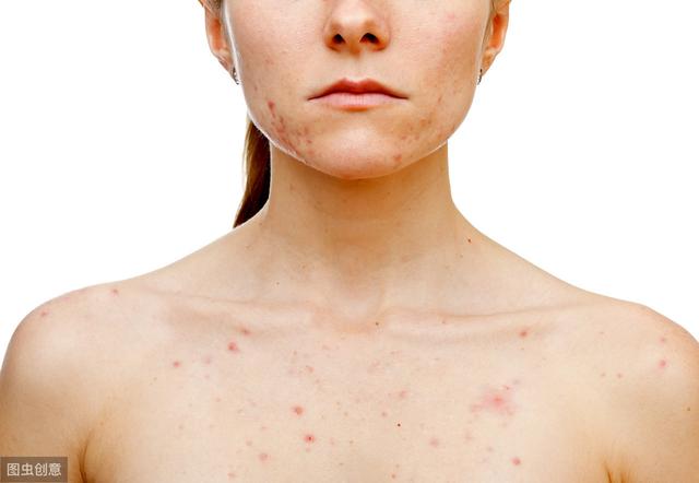 毛周角化症属于真菌病吗