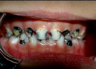 牙齿烂了怎么办?