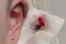 图片慎点！镇江网友打耳洞后发炎感染，耳骨被削，差点畸形图片