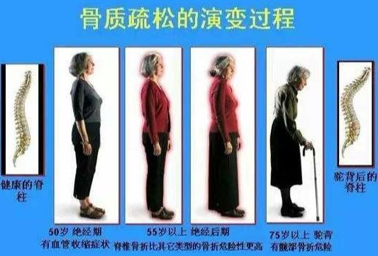 如何预防和治疗骨质疏松症