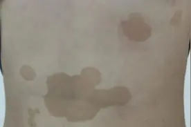 汗斑、花斑癣和花斑糠疹图片