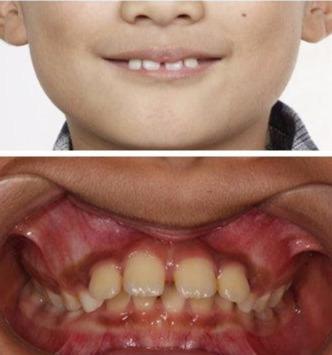 "龅牙"一定要等到换完牙再开始矫正吗?