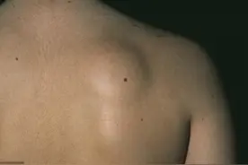 诊断了脂肪瘤，要不要处理？怎么预防脂肪瘤癌变？图片