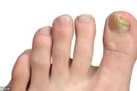 不敢穿凉鞋，做饭遭嫌弃，解除灰指甲传染大问题医生有妙招图片