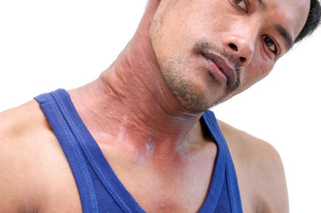 唇炎怎么治,严重性,（他克莫司是什么药为什么见效快使用过程中一定要注意3点事项）