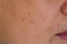 关于黑色素你知道多少图片