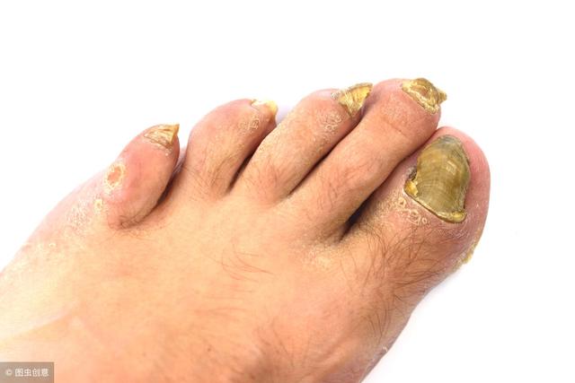 脚指甲很厚很硬怎么办(脚指甲很厚很硬怎么剪) - 星云探秘网