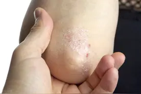 十余年银屑病：所到之处，座椅满布皮屑，服用中药一月几乎消尽图片