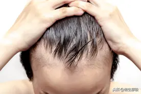 植发后三年头发掉了怎么办？图片