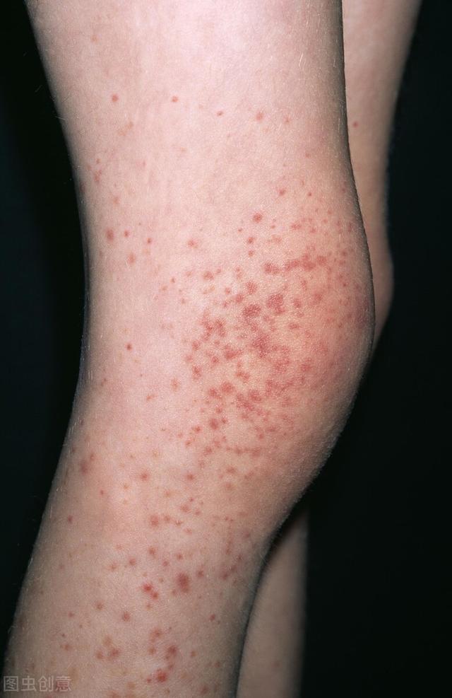 皮肤上有小红血点图片(当你发现身上莫名出现小红点时小心这种疾病)
