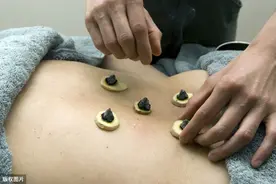 艾灸虽好，切莫贪灸图片