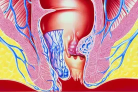 辟谣｜口服无花果叶治痔疮？不！有一种做法有效率90%以上图片