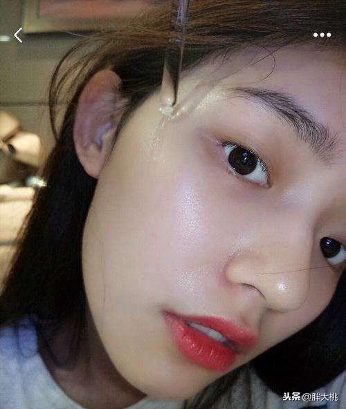 角化异常擦维a酸乳膏脱皮