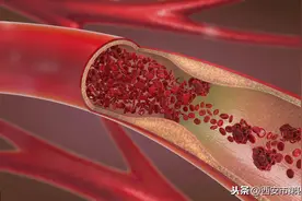 #健康科普汇# 【血栓最爱堵人体的这3个地方】图片