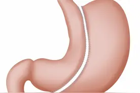 胃切除之后，还能修复正常吗？我们应该注意些什么？图片