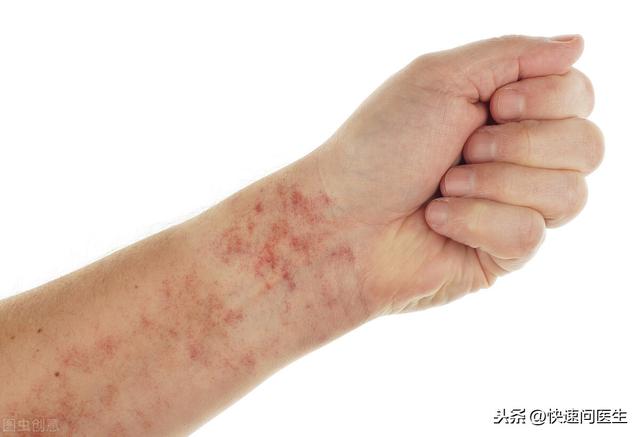 手臂上有很多小红点是怎么回事（手臂上的小红点是什么可能是以下3个原因）