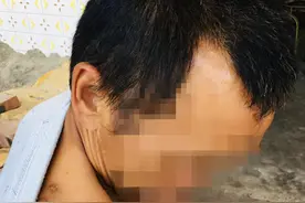 “熊口余生”：村民进山采药被黑熊咬掉半边脸，至今心悸不敢进山林图片