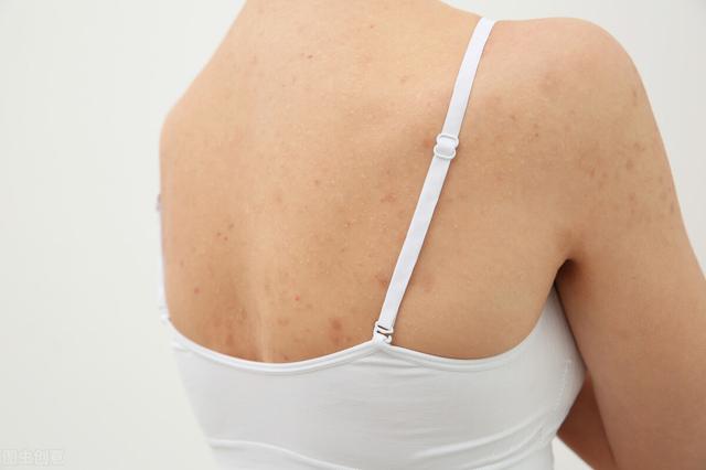 背上长痘痘抹身体乳能消除吗