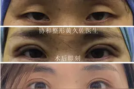 双眼皮（北京协和医院黄久佐）系列案例五：上睑凹陷图片