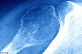 《人间世》中孩子们所患的骨肉瘤是种怎样的疾病？该如何预防？图片
