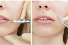 改善鼻唇沟的方法，你都知道吗？图片