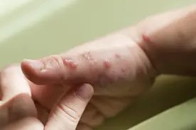 夏季汗疱疹盛行手脚出现小水泡是征兆图片