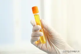我老公两次检查尿酸分别为460和510，没有不舒服，这样需要吃药吗图片