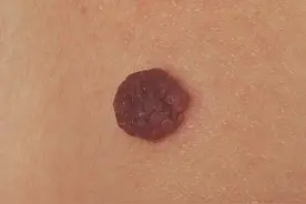 这种常见的肉瘤，竟和HPV感染有关，有这个表现的，当心宫颈癌图片