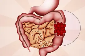 老公屁非常多，一天能放20几个，会是肠癌吗？图片