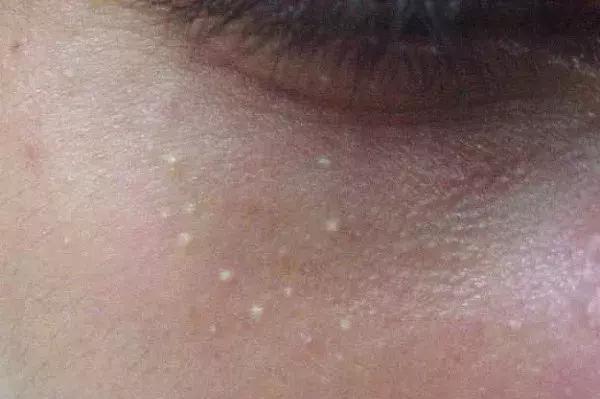 非角化型细胞额