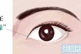 双眼皮眼头眼尾为什么会分叉？双眼皮修复时内外高位疤痕的处理？图片