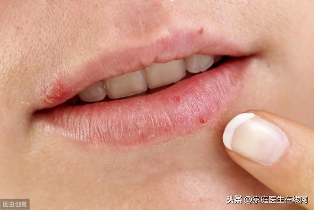 尖锐湿疣表面粗糙角化是什么意思