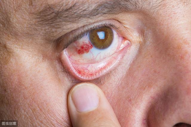 眼睛发红,是结膜炎还是角膜炎?