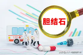 胆结石也可能转成胆囊癌，有些坏习惯是该改改了图片