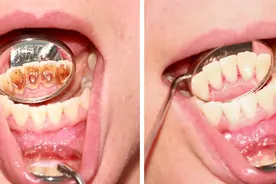 牙龈上长了个“瘤子”是什么东西？严重吗？图片