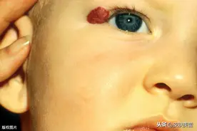 孩子脸上出现红色胎记，搞清这3种情况，处理得心应手图片