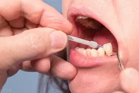 烤瓷牙使用寿命跟什么因素有关？能使用多久？图片