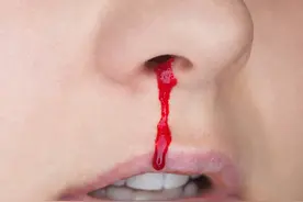 鼻出血的原因有哪些？如遇到鼻出血如何紧急处理图片