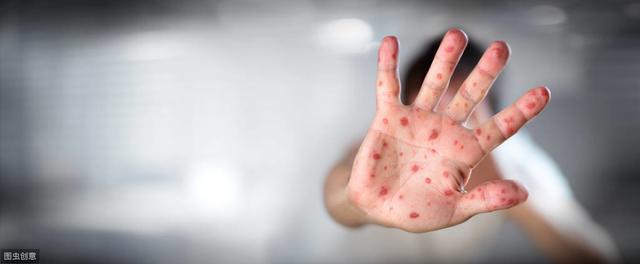 8岁女孩脸部有毛囊角化丘疹