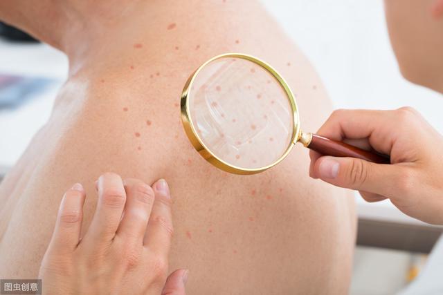 海鲜过敏会有鸡皮疙瘩