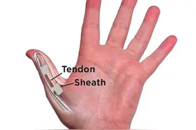 大拇指腱鞘炎多见于这两类人群，该如何治疗？医生给您说清楚！图片