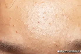 痤疮（痘痘）治疗系列之一—外用维A酸类的药物图片