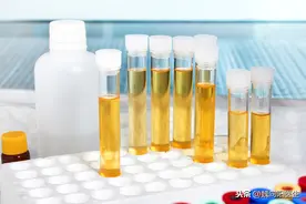 化验尿液前如何收集尿液（手把手教你读化验之6）图片