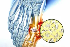 多喝水可以排除尿酸吗？医生：预防痛风，推荐4个好习惯图片