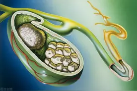 预防胆结石应该这么做，得了胆结石也不用慌图片