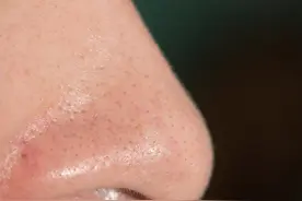 为什么黑头总是去不干净？最全去黑头攻略来也！图片