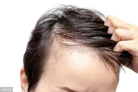 脱发用生姜擦有用吗？为什么这么多男性会秃顶？原因看这里图片