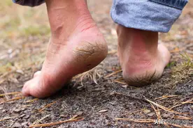 脚后跟开裂抹药好了，今年又"犯"了，年年复发，到底能不能根治图片