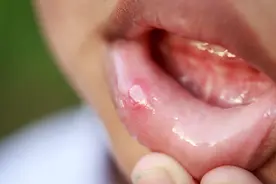 揉一揉，按一按，迅速摆脱小儿口疮图片